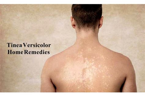 Effective Home Remes For Tinea Versicolor Bios Pics