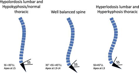 Sagittal Alignment In Spinal Deformity Implications For The Non