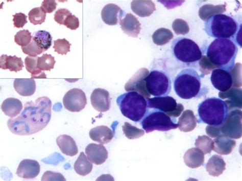 Pancytopenia Following Vivax Malaria In A Cll Patient Blood