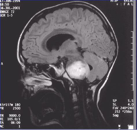 Brain Stem Gliomas Neurosurgeon