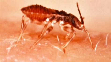 Kissing Bugs Spreading Painful Bites Across Us Nbc News