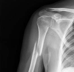 Fracture du bras : symptômes, traitement, définition - docteurclic.com