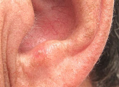 Actinic Keratosis Prevention With Retin A Scary Symptoms