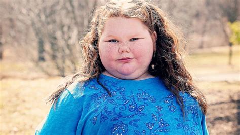 Girl Who Couldnt Stop Eating Gets Her Childhood Back After Surgery
