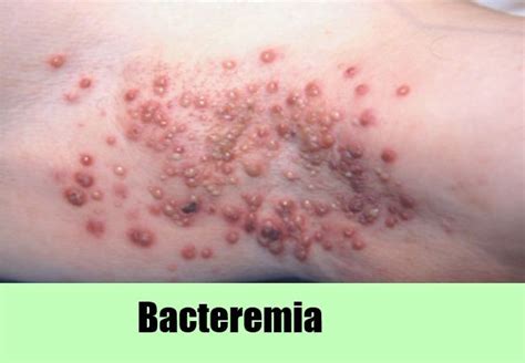 5 Symptoms Of Staphylococcus Natural Remedies Home Remedies Remedies