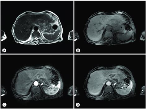 Magnetic Resonance Imaging Of The Liver Showed A Multiseptated Lesion
