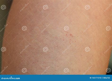 Leg Showing Capillaritis Due To Leaking Capillary Blood Vessels Also
