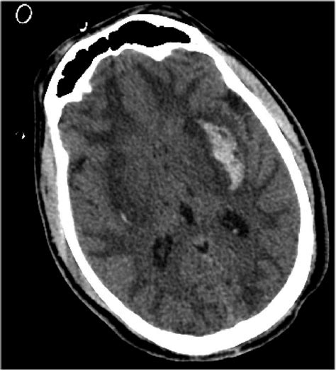 Case 2 Brain Ct Showing Hypodense Confluent Lesions In Superficial