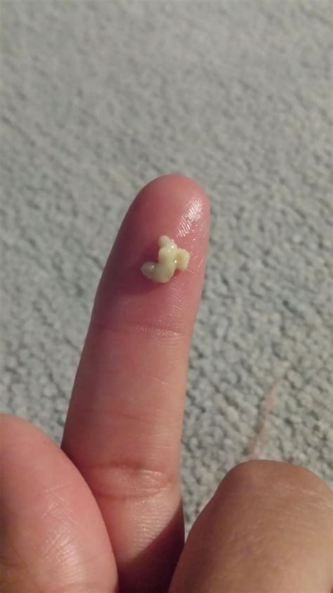 Just Coughed This Up I Think Its A Tonsil Stone Its So Stinky Im So