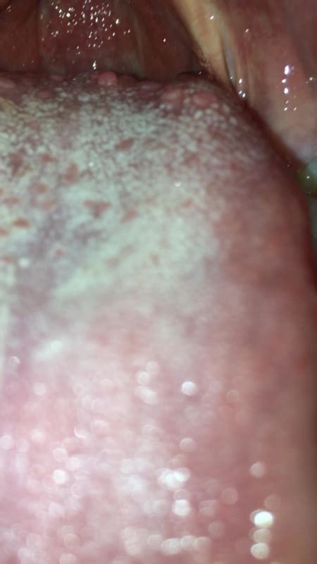 Skin Colored Bumps On The Back Of Tongue Pictures