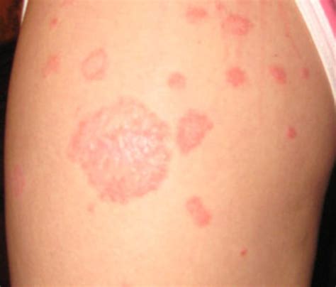 Red Patches On Skin Causes Symptoms And Treatment Hubpages