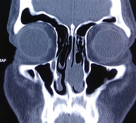 Myoepithelioma Of Nasal Septum A Rare Minor Salivary Gland Tumour
