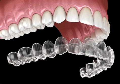 Why Invisalign So Expensive West Hollywood Holistic And Cosmetic