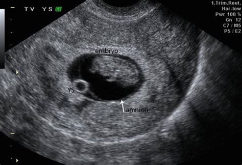 First Trimester Ultrasound Early Pregnancy Failure First Trimester