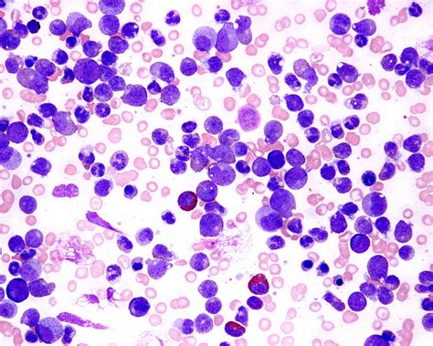 Bone Marrow Core Biopsy May Be Beneficial In Workup For Chronic Myeloid
