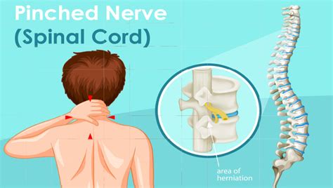 Pinched Nerve Pain Phoenix And Peoria Haggard Chiropractic