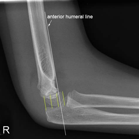 Elbow Supracondylar Fracture Cases Wikiradiography