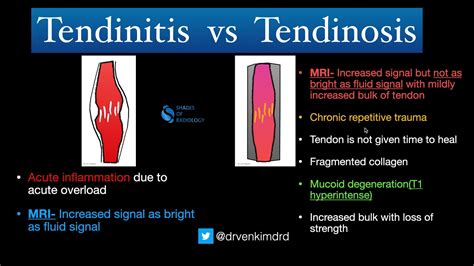 Tendinitis Vs Tendinosis Simplified Youtube