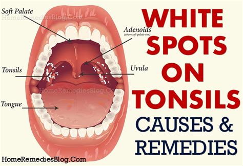 How To Get Rid Of White Spots On Tonsils Causes And Home Remedies Home