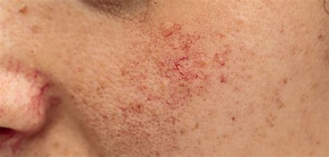 Broken Capillaries Causes And Treatment Options In Vancouver
