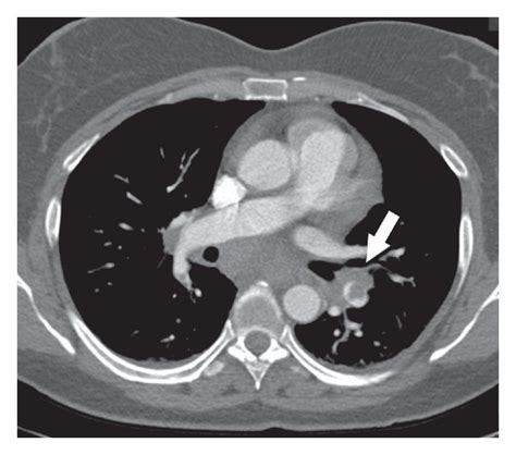 Axial Ct Image Demonstrates Pulmonary Embolism Within The Left Download Scientific Diagram