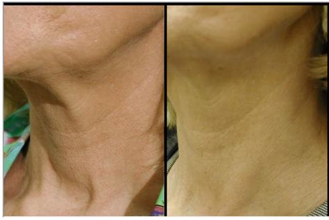 Procedure Clearlift The New Laser Approach To Neck Skin Tightening