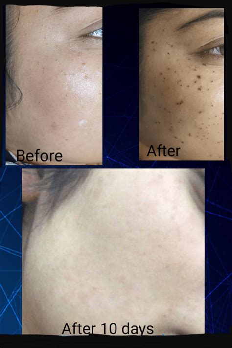 Skin Pigmentation White Spots Removal Asmara Holistic And Aesthetic Clinic