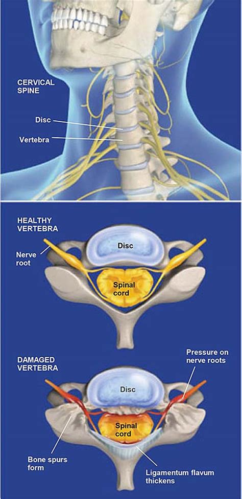 Spinal Stenosis Cervical Central Coast Orthopedic Medical Group