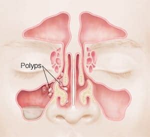 Nasal Polyps Treatment Without Surgery NaturalCure Openzimzim Com