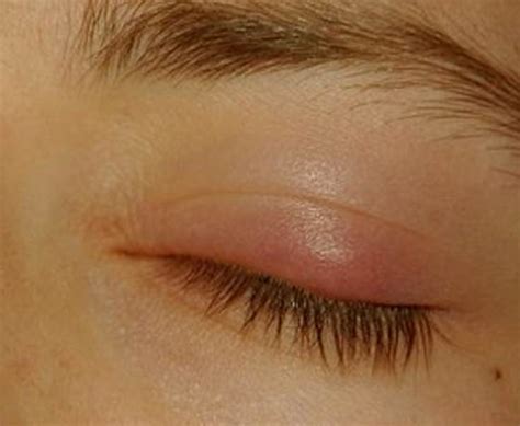 Eyelid Bump Types Causes And Treatment Reverasite
