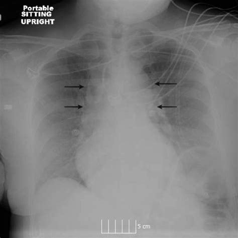 Ct Of The Chest Showing Saddle Emboli White Arrows In Main Pulmonary