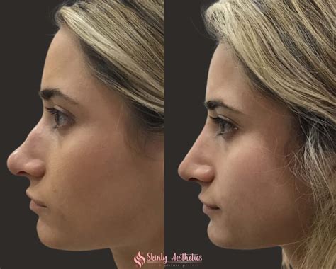 Non Surgical Rhinoplasty Quick Effective And Minimally Invasive
