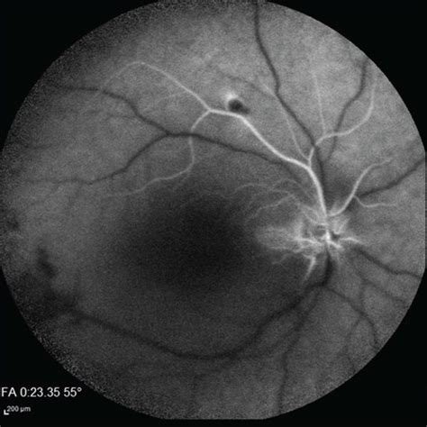 Fundus Photography A Optical Coherence Tomography C D And