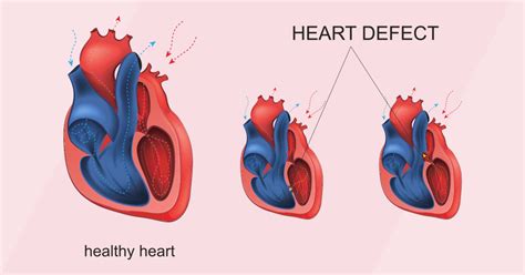 Congenital Cardiac Defects Overview And Practice Questions