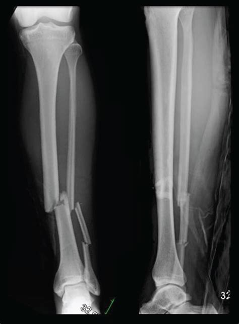 Anteroposterior Ap And Lateral Radiographs Of The Left Leg