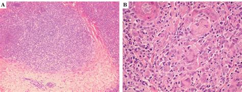 Histopathologic Examination Revealed Dermal Granulomas Of The Sarcoid