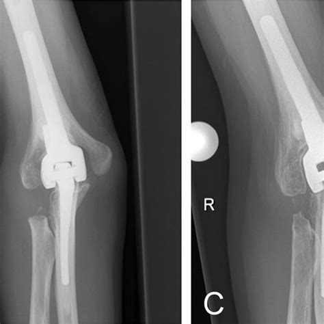 Pdf Long Term Results Of Total Elbow Arthroplasty In Patients With