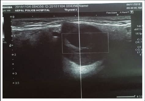 Usg Neck Showing A 30 X 24 X 21 Cm Well Defined Hypoechoic Lesion In