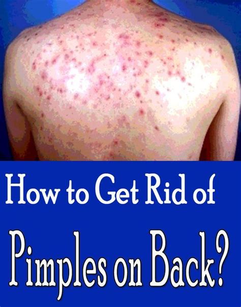15 Home Remedies For Pimples On Back Styles At Life Back Acne