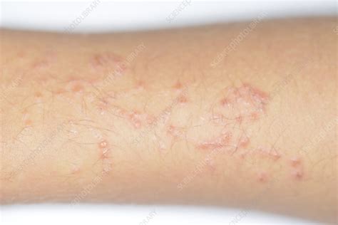 Allergic Reaction To Henna Tattoo Stock Image C0263301 Science