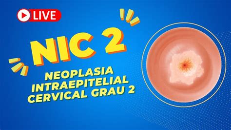 Nic 2 Neoplasia Intraepitelial Cervical Grau 2 Neoplasia Do Colo Do