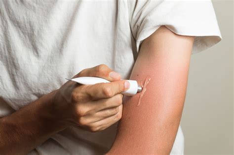 how to properly treat a sunburn