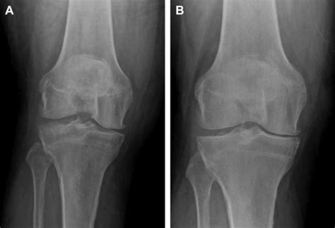 Imaging Of Osteoarthritis Of The Knee Radiologic Clinics