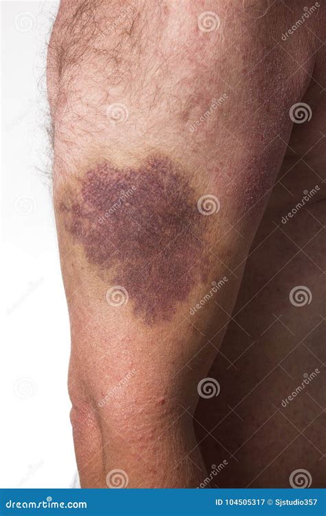 Big Bruise On Hand On White Background Stock Image Image Of Injuries