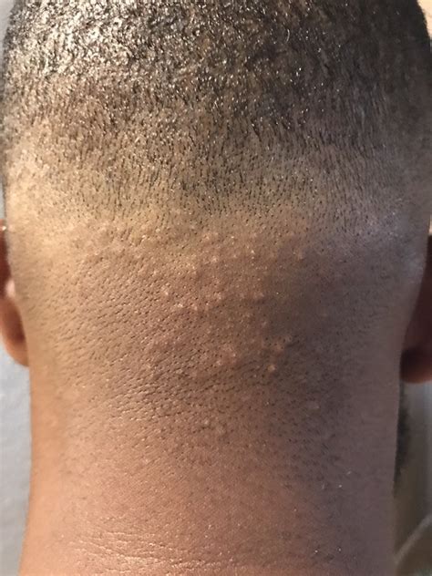 Razor Bumps After Haircut What Hairstyle Should I Get