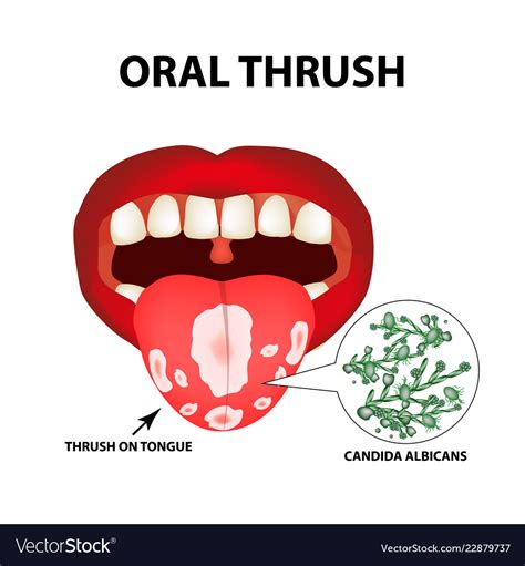 Oral Thrush Candidiasis On Tongue Fungus In Vector Image