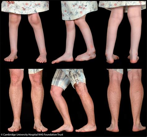 Clinical Photographs Showing Muscle Atrophy And Foot Deformities In The