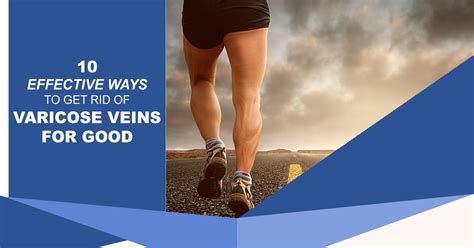 10 Effective Ways To Get Rid Of Varicose Veins On Your Legs For Good