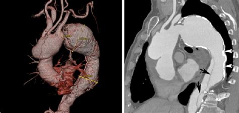 Left Preoperative 3d Reconstruction Vrt Of Contrast Enhanced