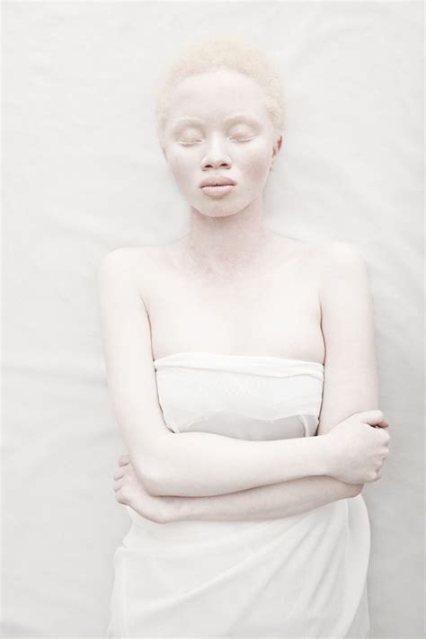 In South Africa One Photographer Breaks The Taboo Surrounding Albinism